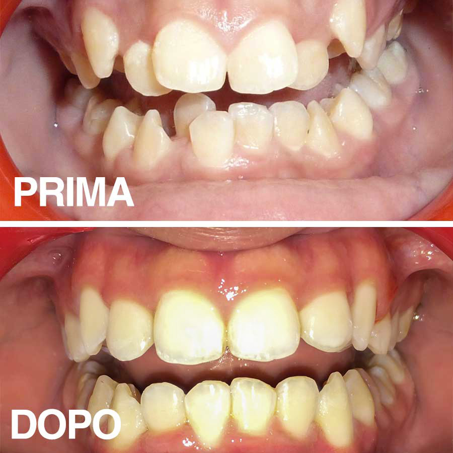 Denti: apparecchio invisibile. Per cosa si usa, benefici e consigli